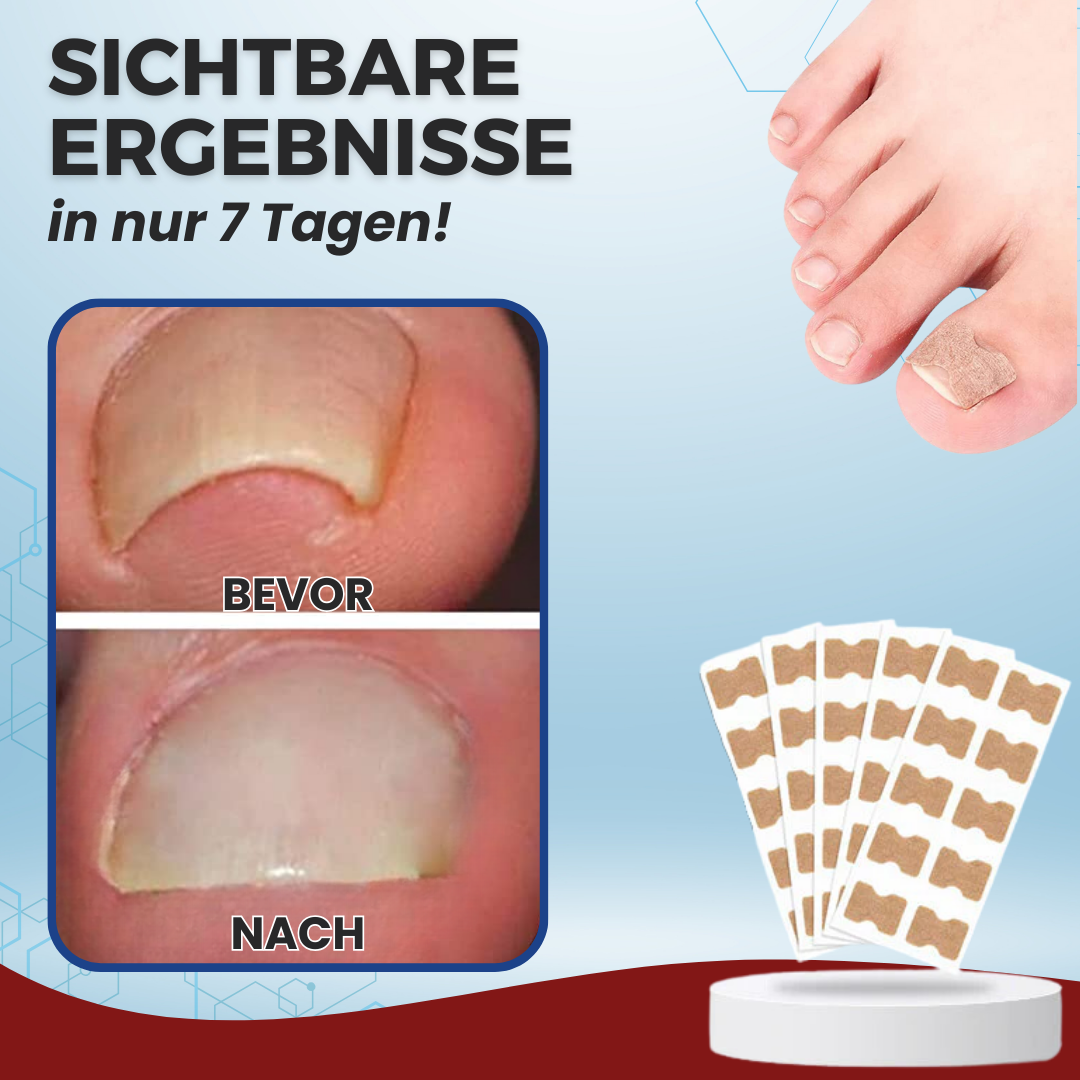 AEXZR® Paronychien-Korrekturpflaster - LIMITED-TIME OFFER | Lassen Sie das beste Selbstvertrauen in sich heraus!💕