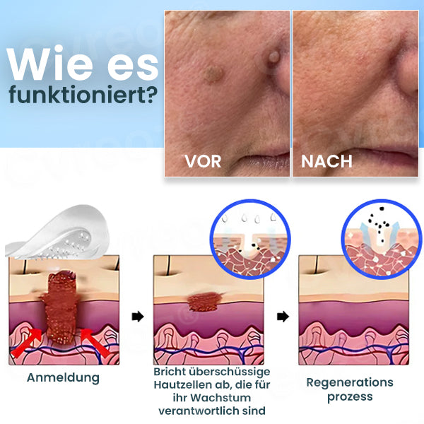 Cvreoz® Pro Microdarts Tags' weg Flicken - BEFRISTETES ANGEBOT | Skin Tag No More!!! 💕