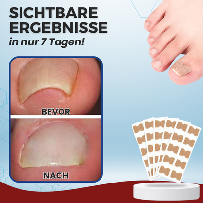 AEXZR® Paronychien-Korrekturpflaster - LIMITED-TIME OFFER | Lassen Sie das beste Selbstvertrauen in sich heraus!💕